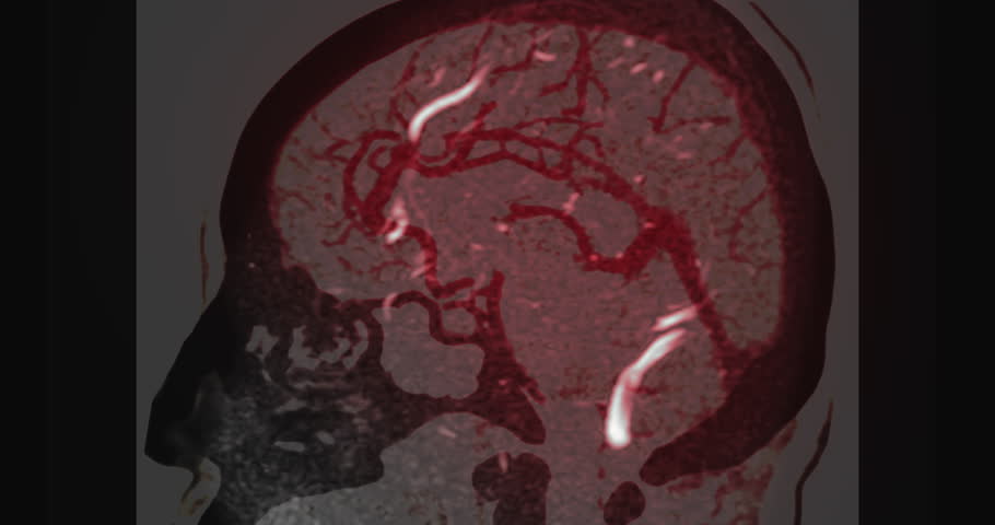 MR cerebral venography (MRV) or MRV Brain for diagnostic Cerebral venous thrombosis (blood clots in the brain) and Structural vein abnormalities.