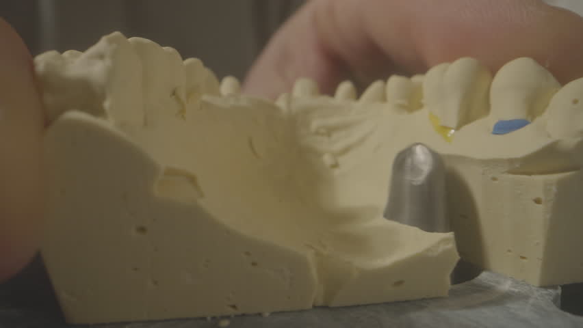 Closeup dental cast inspection on workbench with technician hands, gypsum model pin and abutment visible, careful trimming