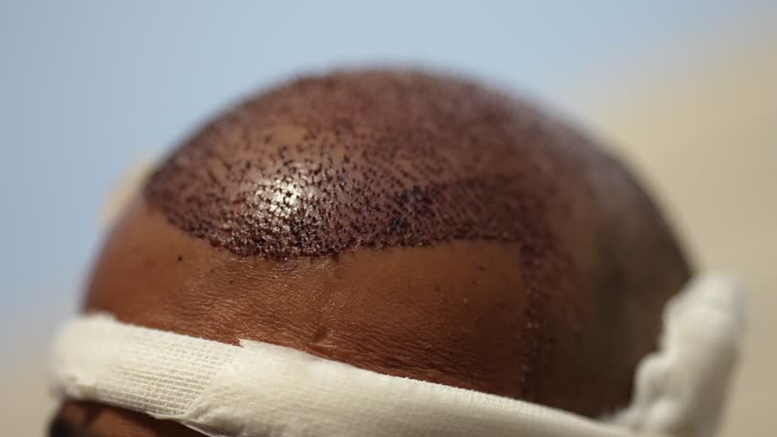 Close-up video of early stage hair growth after transplant, showing new follicles, scalp healing, and natural restoration progress.