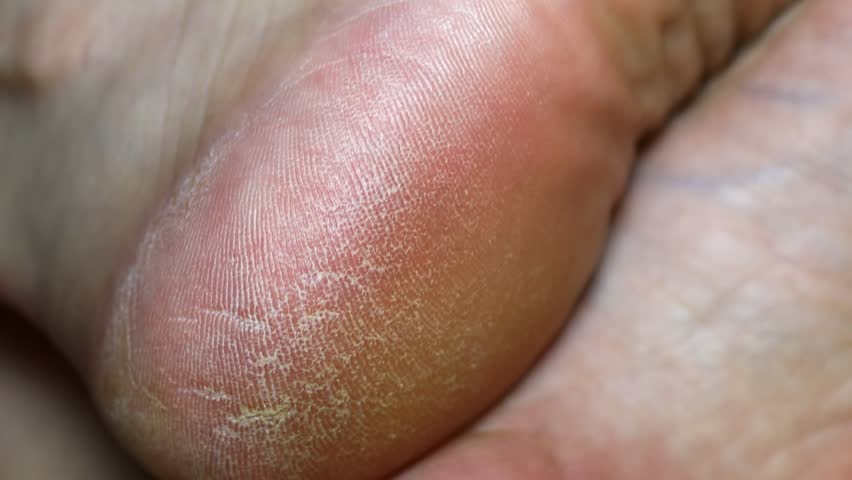 human feet with calluses close-up.