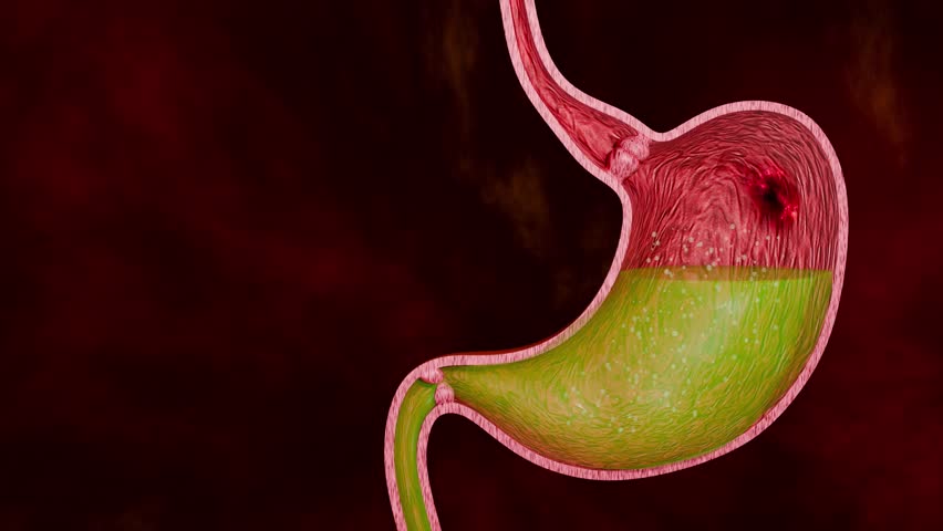 Digestive System Pathology Illustration Featuring Gastric Ulcer Injury, Stomach Tissue Abnormality and Cancer Risk Concept 3D Rendering
