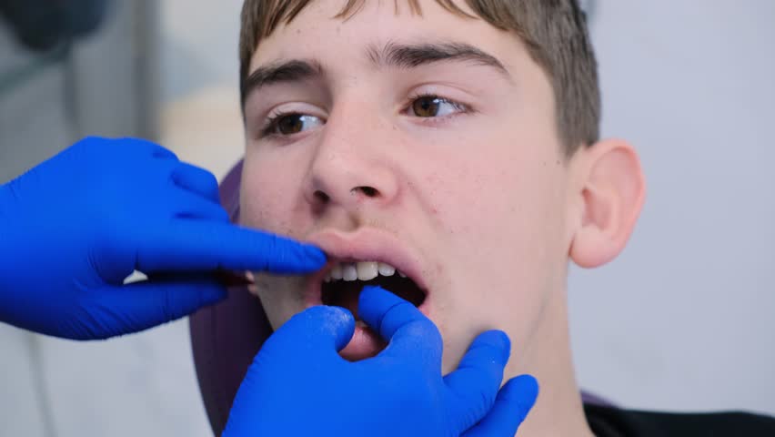Process of fitting a single removable dental prosthesis for a teenage boy. Dentist adjusts butterfly tooth prosthesis in the upper jaw of patient using dental articulation paper. Dental prosthetics