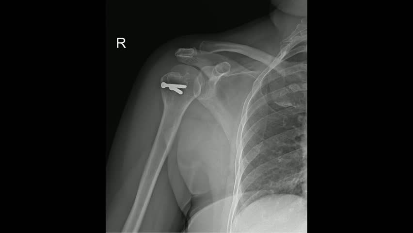 Post-operative X-ray of Right Shoulder with Humeral Head Screw Fixation