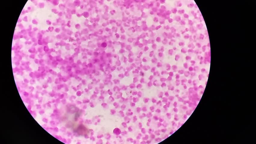 Specimen: Urethral smear Patient 22 years (male). Gram's stain Findings: Gram negative diplococci, both intra and extracellular (profuse).