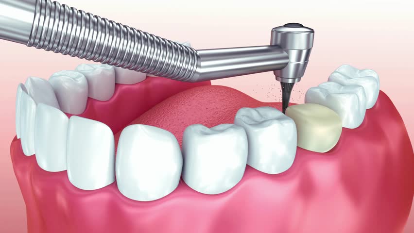 A close-up 3D animation of a dental handpiece and bur being used to shape and prepare a natural tooth for a prosthetic crown.