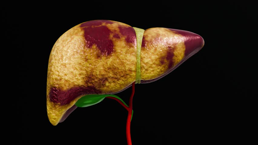 Fatty Liver Disease and Liver Cancer Concept Showing Damaged Human Liver Anatomy with Abnormal Tissue Texture for Medical Education and Healthcare Awareness 3D Rendering
