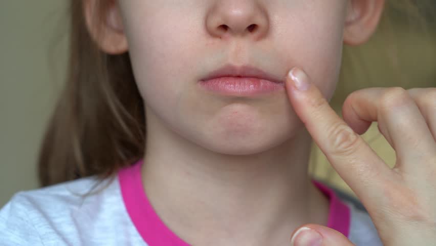 Mothers hand applies ointment to mouth of child with angular stomatitis. Close up of girls face with perleche. Angulit. Disease illness. Medicine. Healthcare
