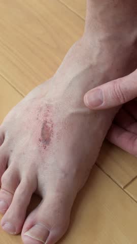 Man shows badly scratched foot with scabbed abrasion and red irritation at home, closeup skin injury from severe itching.