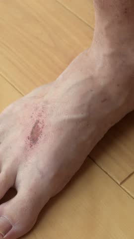 Man applies ointment on scratched foot wound with scab at home, closeup skin treatment for itching rash, irritation relief.