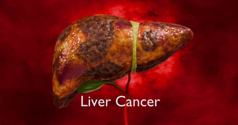 Liver Disease Progression Showing Five Stages from Healthy Liver Fatty Liver Fibrosis Cirrhosis to Liver Cancer for Medical Education and Health Awareness 3D Rendering
