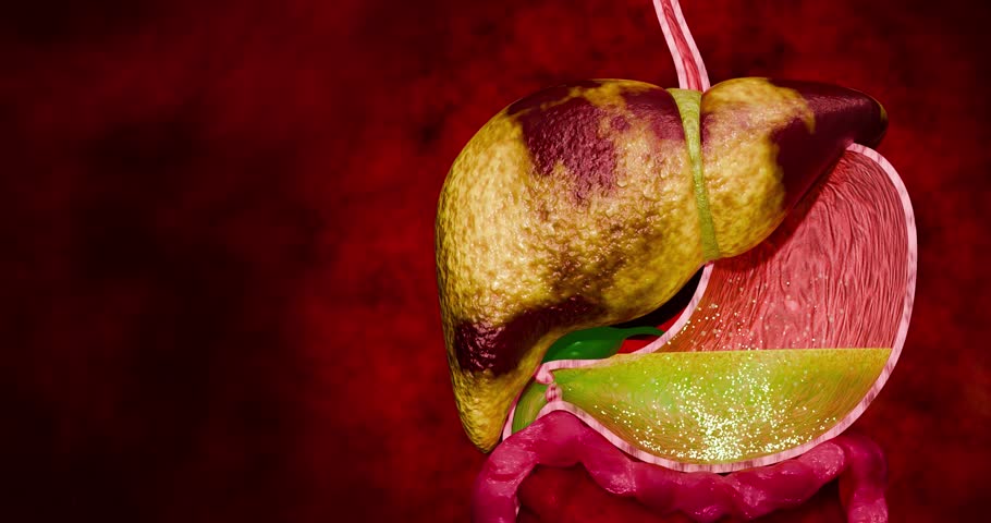 Liver Disease Concept Linking Fatty Liver and Cancer with Fast Food Diet Sleep Deprivation and Sedentary Lifestyle in Medical Anatomy 3D Rendering

