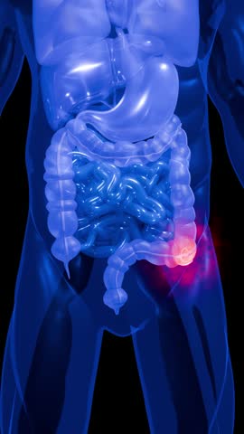 Colon Cancer Anatomy Illustration Showing Tumor in Large Intestine and Digestive System for Medical and Healthcare Use 3D Rendering
