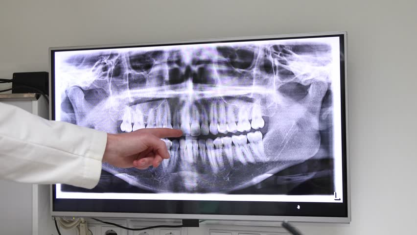 Medical professionals pointing at a screen showing a panoramic dental radiograph. Two doctors discussing a patient's jaw and teeth