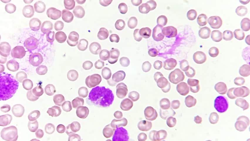 Microscopic footage of Acute leukemia. Grossly increased WBC, left shift, atypical looking large mononuclear cells.