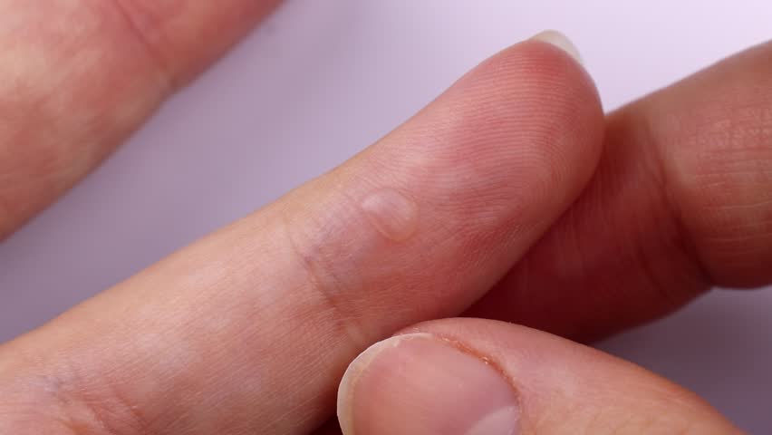 Typical skin burn blister on the finger from second-degree boiling oil burns close up