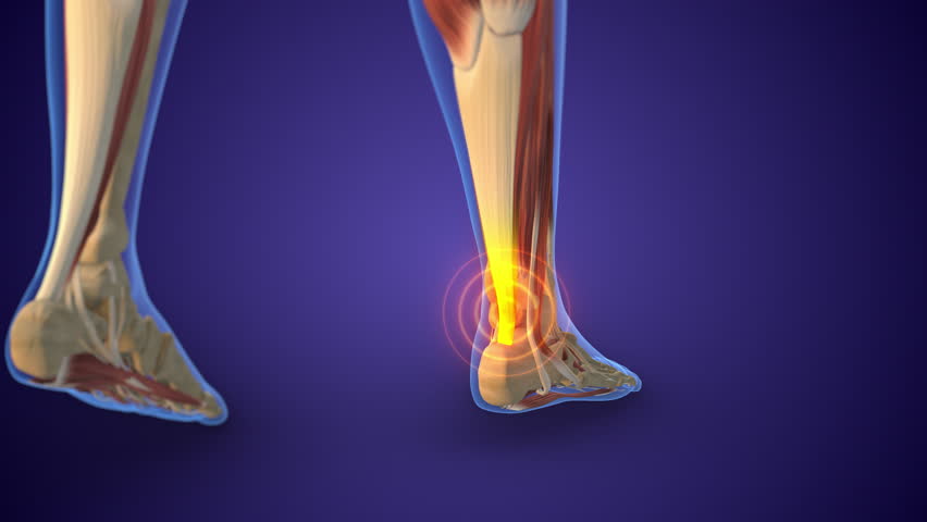 Achilles Tendon Injury with Pain Highlight in Human Ankle