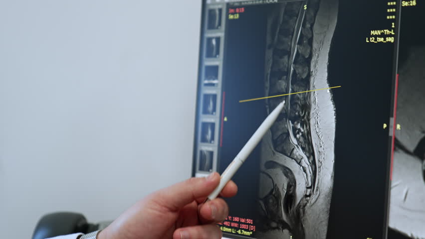 Male hand holding a pen points at the MRI scan of the patient. Doctor displays the problem on the shot. Close up.