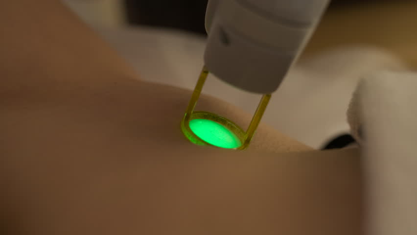 Macro shot of diode laser pulses destroying hair follicles during epilation procedure