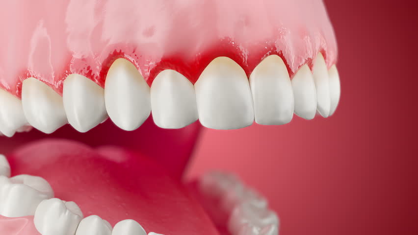 3d animation of teeth and oral health showing gum disease and inflammation.