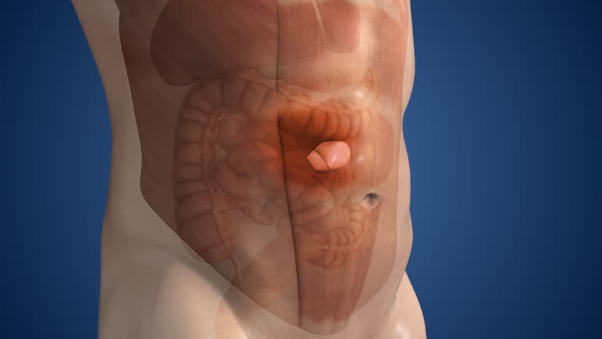 Epigastric Hernia Formation in Upper Abdomen