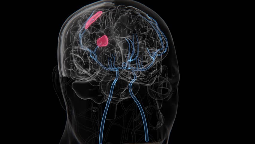 Hemorrhagic Brain Stroke in HD Video | Stroke Hemorrhagic HQ Video | Brain Stroke
