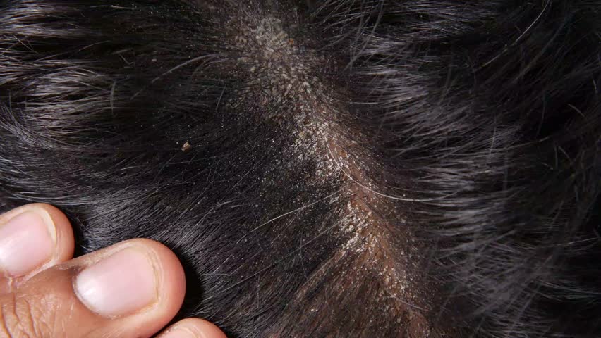 Close up video footage of a person's fingers showing a scalp with dandruff on black hair, highlighting a common dermatological condition, motion footage