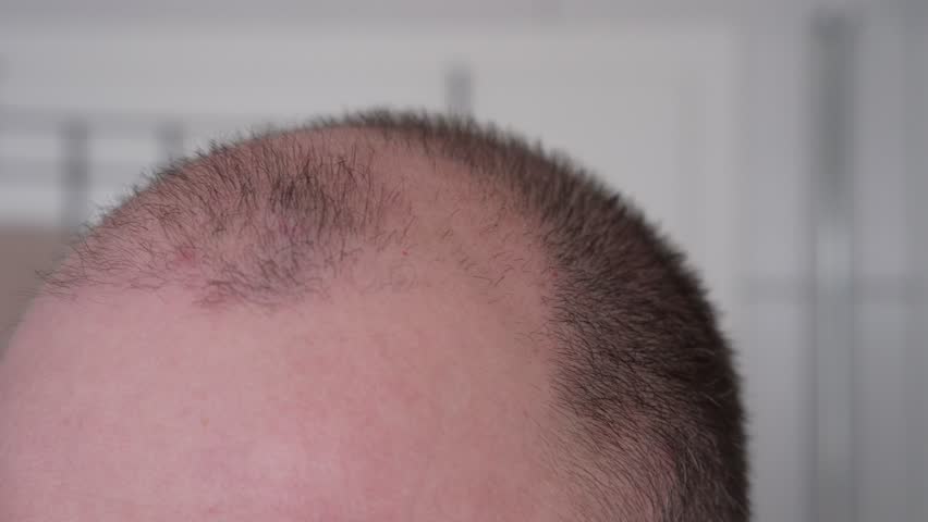 Close-Up of a Man's Receding Hairline Showing Signs of Thinning Hair and Beginning Baldness
