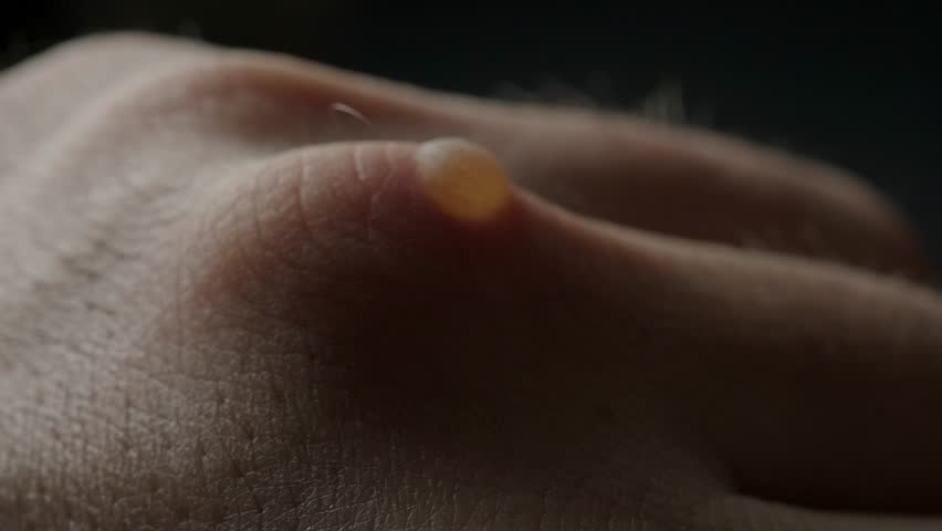 Macro video showing a 1 cm square burn blister on a man's hand at the base of the middle finger knuckle, black background.