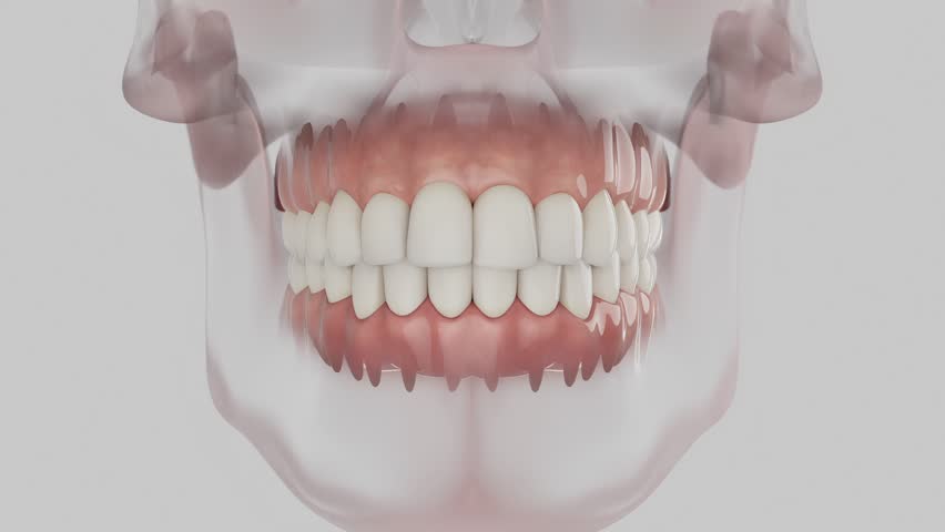 3d medical animation showing periodontal disease with severe gum infection, bone loss, and damaged teeth