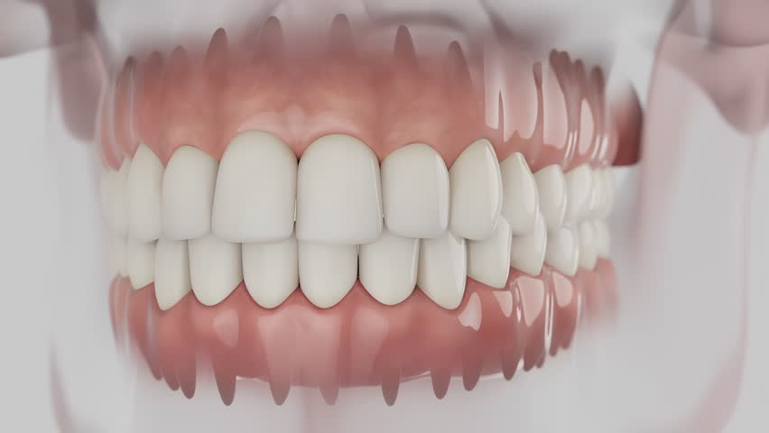 3d medical animation illustrating the advanced stage of gum disease where periodontitis causes gum recession, bone loss, and loose damaged teeth.