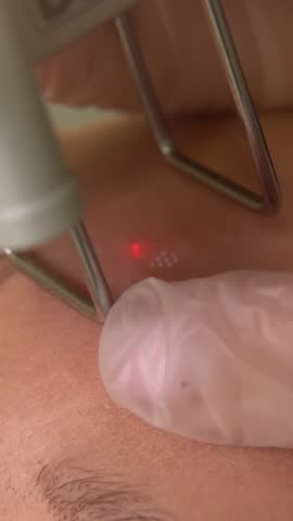 Vertical video showing precision laser skin resurfacing for aesthetic facial enhancement.
A high quality artistic close up capturing a bright red beam of light moving across the surface to promote youthfulness and clarity during an expert beauty session