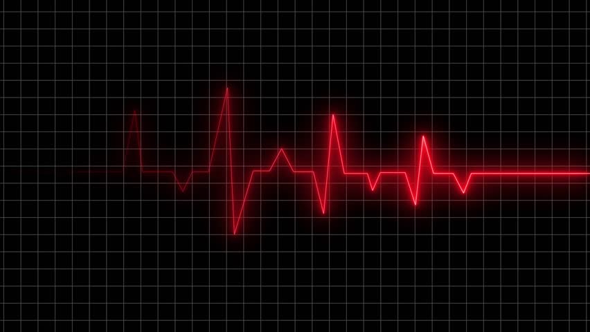Electrocardiogram displaying irregular heart rhythms on a medical monitoring screen