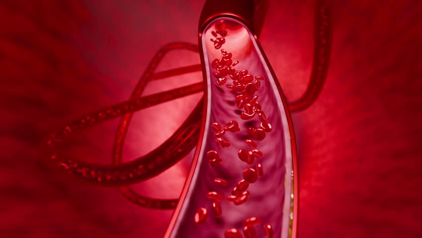 Artery narrowing due to cholesterol deposits, fast food intake, high-sugar beverages, alcohol addiction, and processed foods, emphasizing risks stroke, and cardiovascular death. 3D rendering
