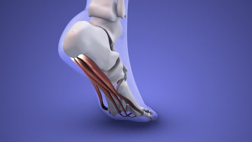 Plantar Fasciitis Causing Heel Pain and Inflammation