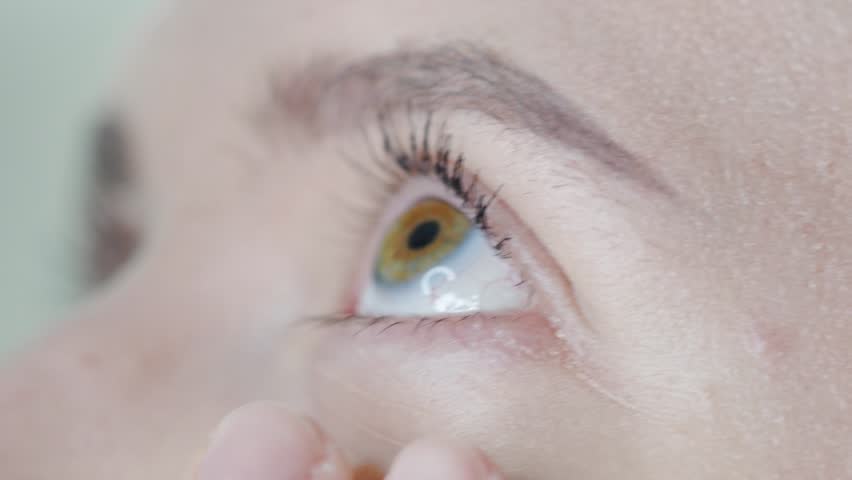 A tired girl puts eye drops in her eyes to relieve fatigue after allergy. Close up of a woman with green eyes