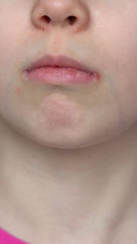 Mothers hand applies ointment to mouth of child with angular stomatitis. Girls face with perleche. Angulit. Vertical shot