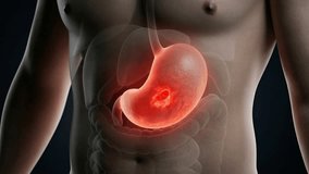 Human torso with transparent digestive system showing inflamed stomach ulcer inside the abdomen in medical view - Powered by Shutterstock - Get 15% off with code: PIKWIZARD15
