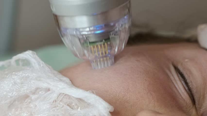 Close-up of a cosmetic microneedling procedure on a woman’s face in a beauty clinic. A professional skincare device is applied to the cheek area to improve skin texture, stimulate collagen production,
