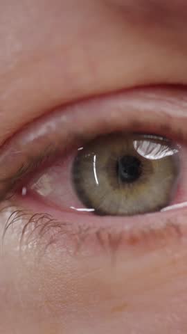 Red blood eye of woman affected by conjunctivitis or after flu, cold or allergy