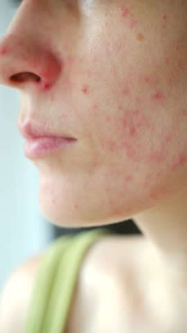 Close up young woman face with red allergic rash, displaying symptoms of atopic dermatitis, rosacea, or skin irritation caused sensitivity to food or cosmetics. Woman showing facial skin allergy rash