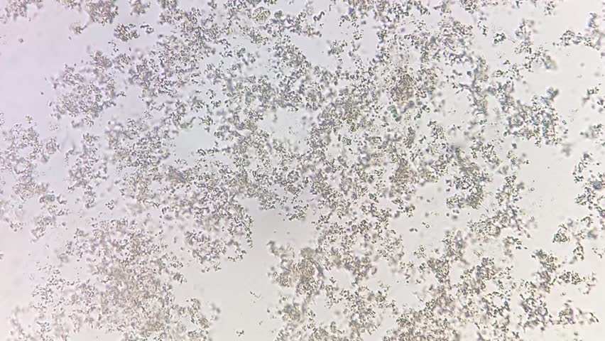 Amorphous Phosphate in urine under microscope. Urine microscopy showing amorphous Phosphate.