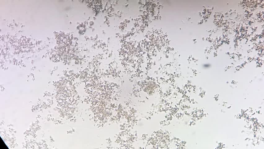 Amorphous Phosphate in urine under microscope. Urine microscopy showing amorphous Phosphate.