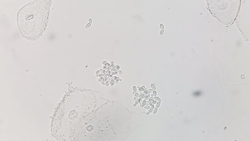 Yeast or candida cells and epithelial cells under microscope. Urine microscopy showing Yeast cells.