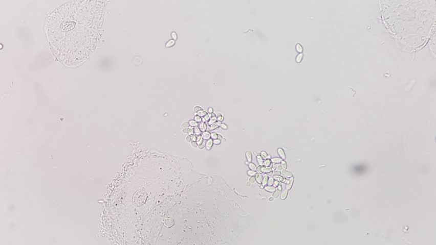 Yeast or candida cells and epithelial cells under microscope. Urine microscopy showing Yeast cells.