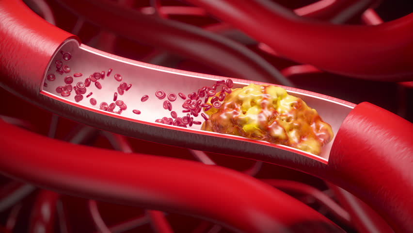 3D animation of medicine particles flowing into a cholesterol-clogged blood vessel, dissolving the plaque and restoring normal blood circulation. Medical concept for heart health.