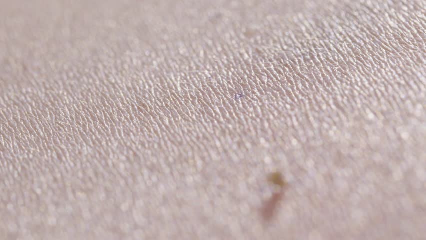 Honey Bee Stinging Human Skin with Visible Stinger Close Up Macro