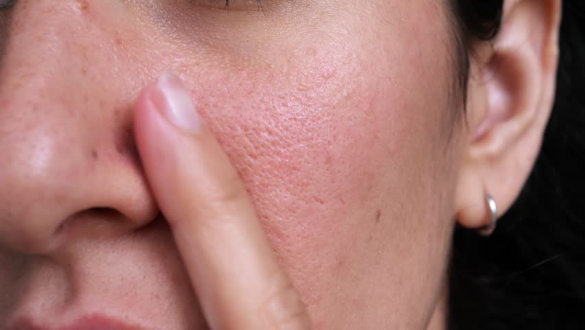 Extreme macro of a woman pressing her cheek with a fingertip to reveal enlarged pores, redness and freckled skin texture, honest unretouched skincare and dermatology close-up