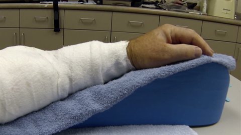 Medical man arm in bandage after major surgery. Man in hospital physical therapy recovery room after major serious arm reconstruction surgery. Male pain killer and anesthesia. Medical advancement. 