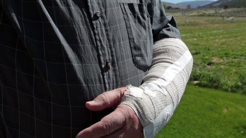 Injured arm in protective cast mature man. Prosthetic arm brace rubs arm in pain after accident. Mechanical medical prosthesis, compression bandage and glove used to stabilize elbow after surgery. 