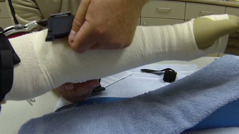 Doctor installing arm brace on patient arm. Man in hospital recovery physical therapy room after major serious arm reconstruction surgery. Arm and hand bandaged and in sling. Male anesthesia. 